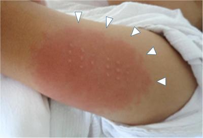 Erythema and Induration of Bacillus Calmette-Guérin Scar Associated With Multisystem Inflammatory Syndrome in Children in Japan: A Case Report